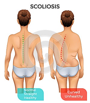 Normal healthy spine and curved spine with scoliosis photo